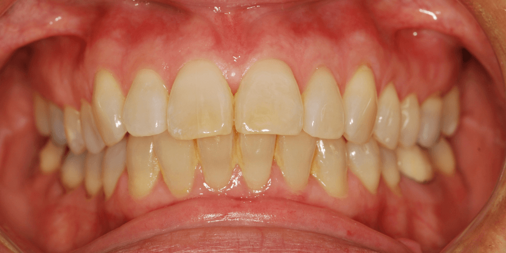 Periodoncia en la clinica dental en Puerta de Toledo