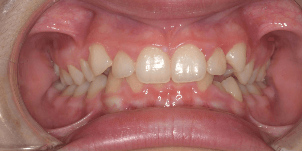 Periodoncia en la clinica dental en Puerta de Toledo
