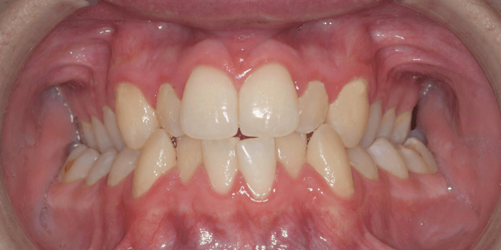 Periodoncia en la clinica dental en Puerta de Toledo