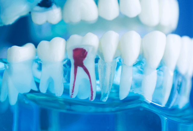 Endodoncia Dental