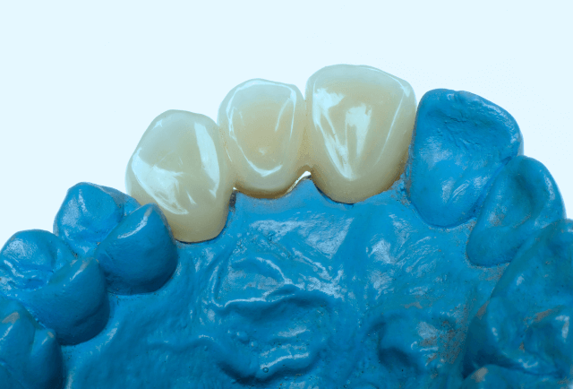 Prótesis dental