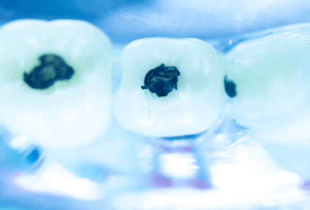 Empastes y Reconstrucción Dental