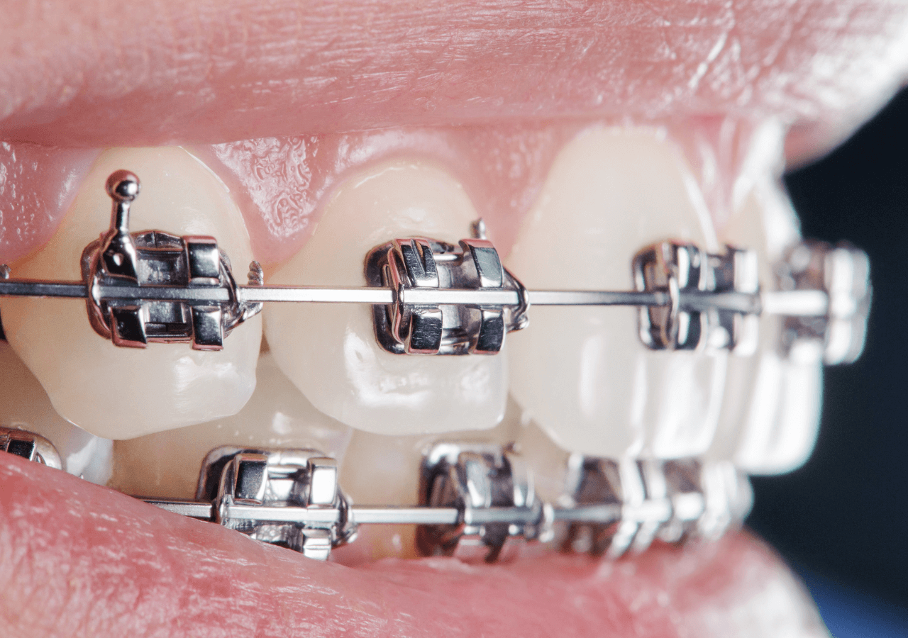 Brackets clínica dental Madrid