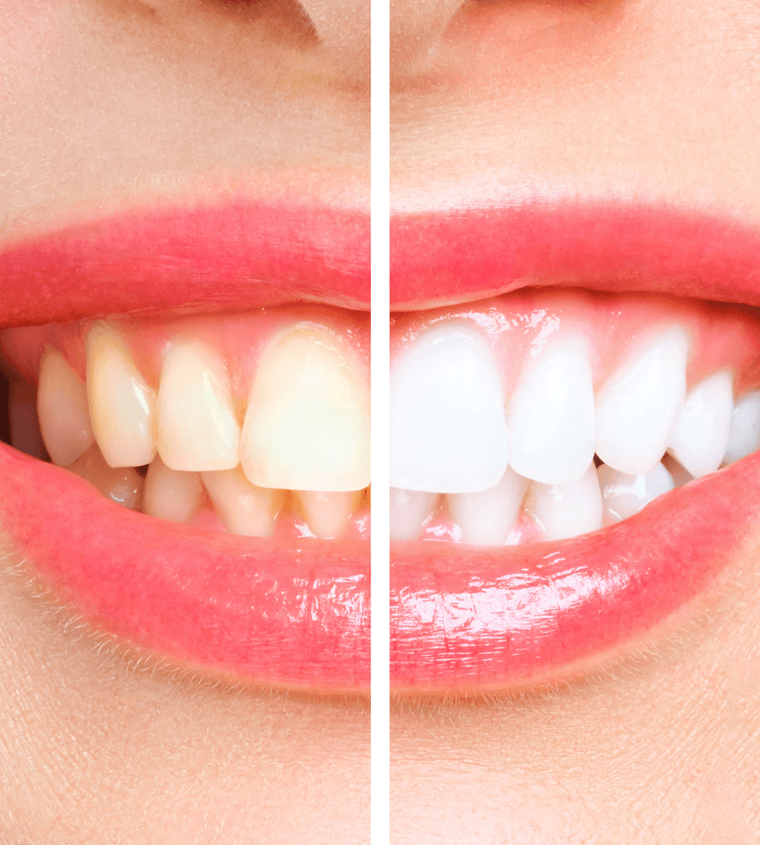 Comparación ilustrativa del tono dental antes y después de un blanqueamiento