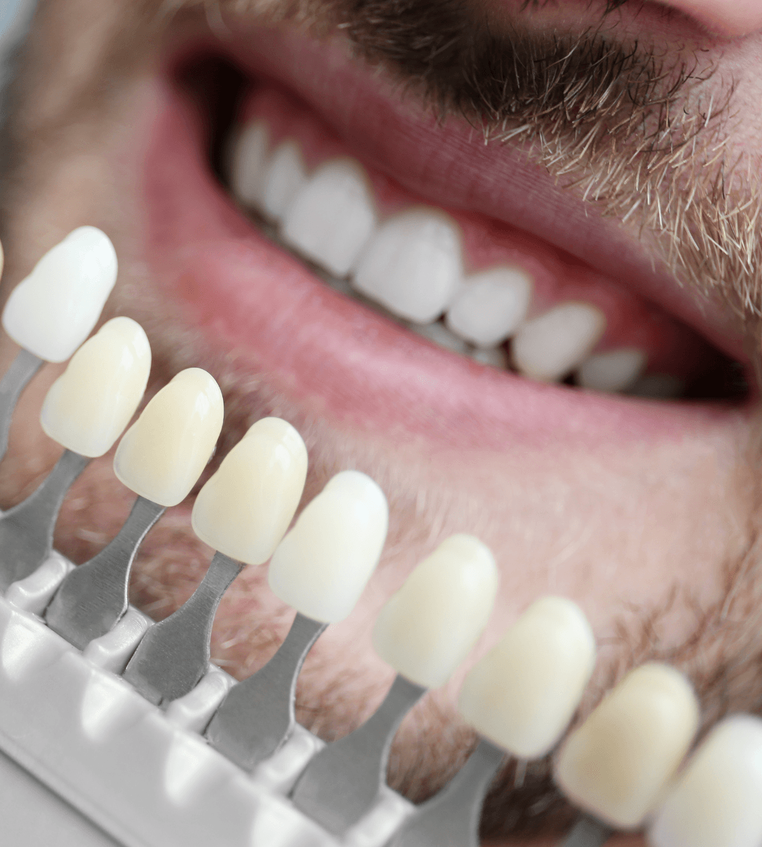 Guía de color dental junto a la sonrisa de un paciente